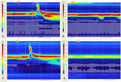 Case report: A case of novel treatment for retrograde cricopharyngeal dysfunction